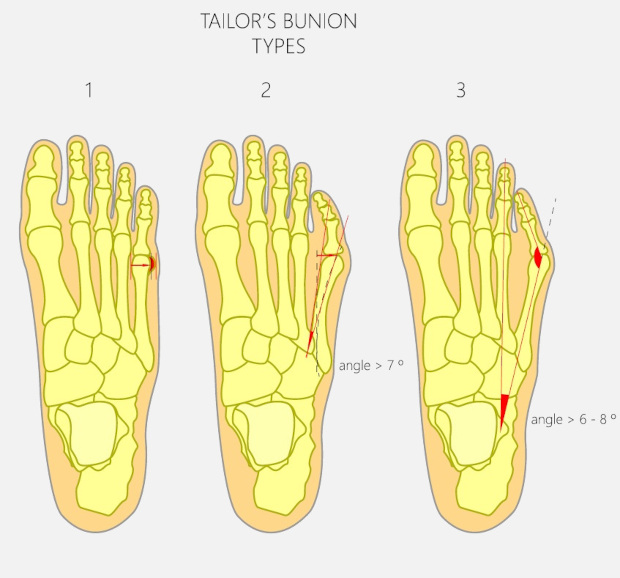 bunion