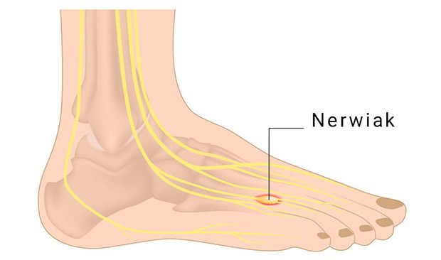 nerwiak Mortona choroba stopy new