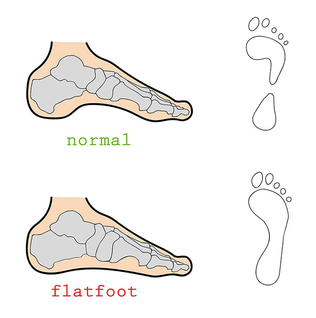 plaskostopie i zdrowa stopa